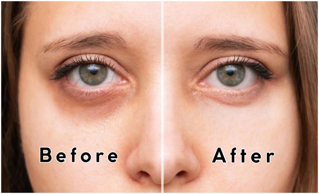 Dark Circles before and after